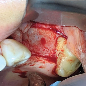 Full flap exposure revealing lateral wall of the maxillary sinus.