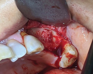 . Sinus window with particulate biomaterial.