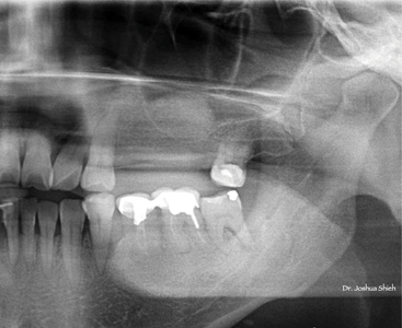Post surgical radiograph showing newly augmented bone within the maxillary sinus.