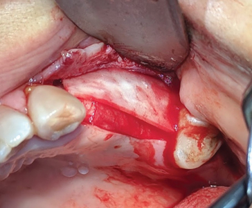 Acellular dermal matrix placed over the collagen membrane to improve tissue biotype.