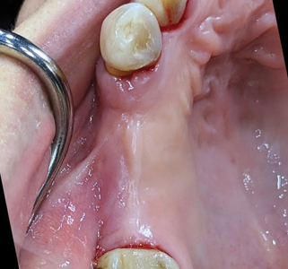 4 month follow up showing well healed site with
thicker tissue biotype and well contoured alveolar ridge