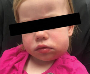 Initial clinical presentation - frontal view, swelling lower left.