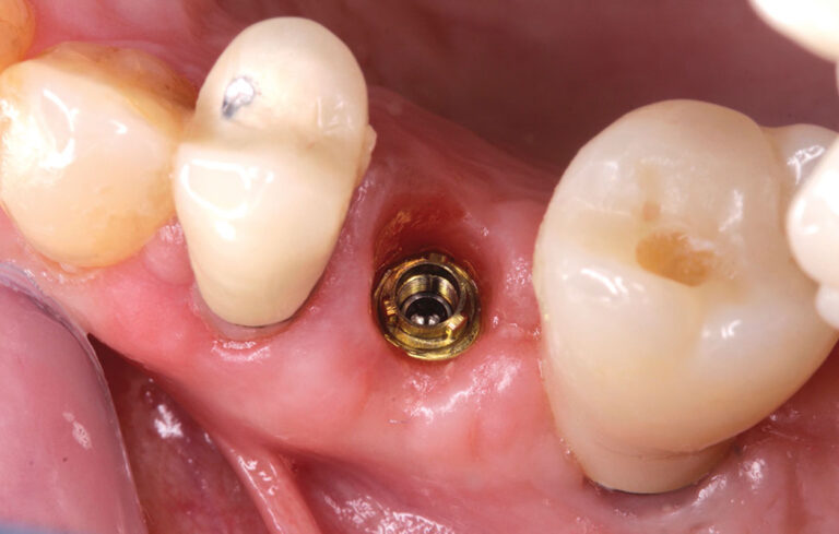  2-week Post-op occlusal view with provisional crown removed. 