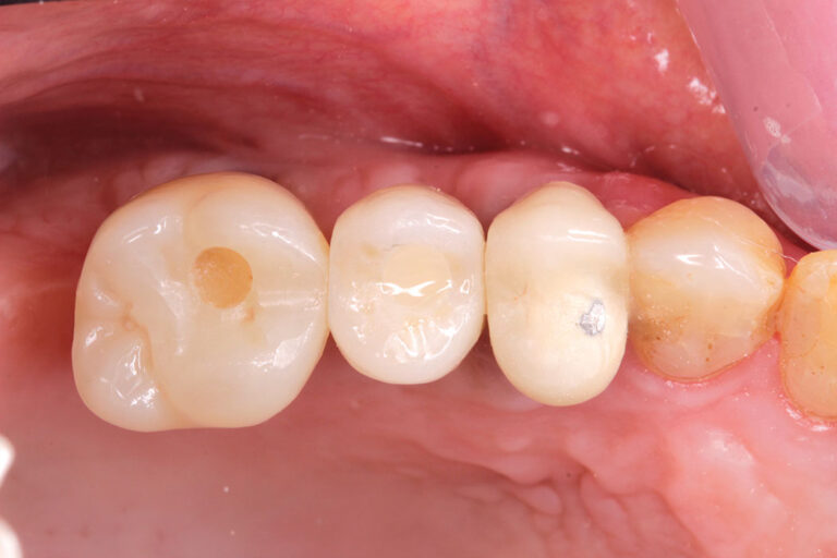 Final crown in place at 2 weeks (occlusal).