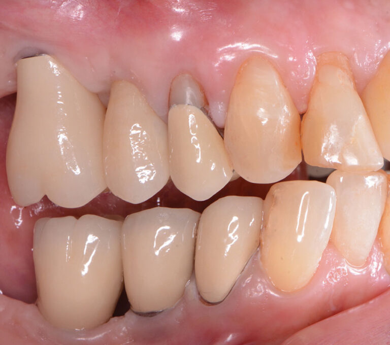 1-year follow-up (buccal).