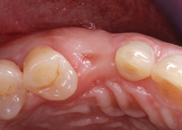 Initial buccal presentation for Case 2.