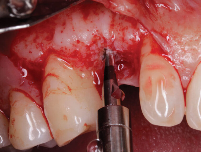 OsseoDirectorTM being used to start the osteotomy.