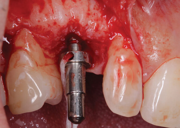 . Directional indicator in place for radiographic analysis.