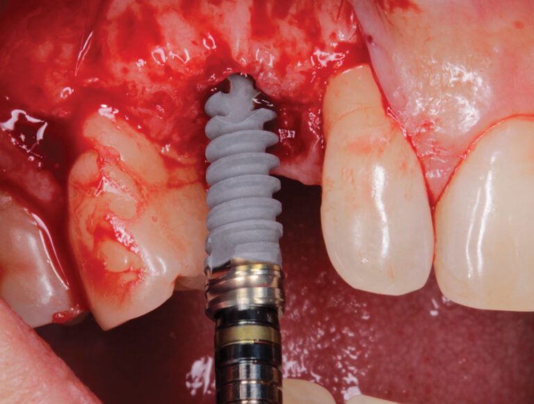 Implant placement (buccal).