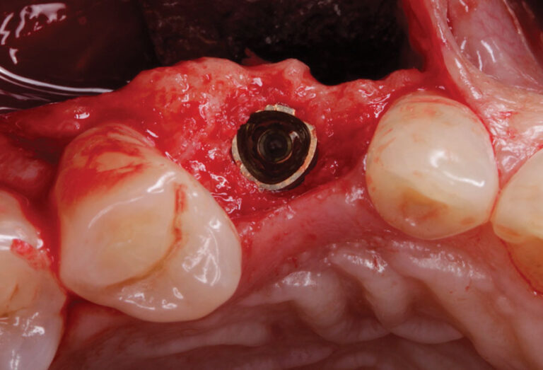 . Flat aspect of trioval shape oriented to the buccal aspect.