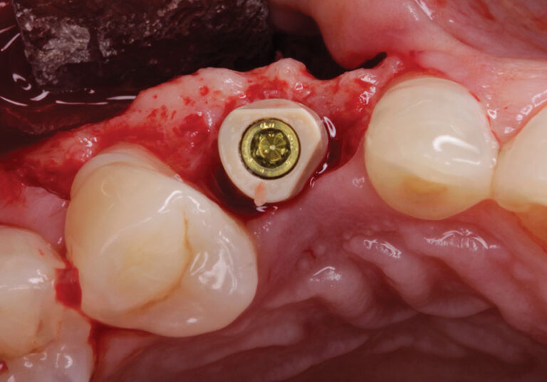 . IOS healing abutment in place.