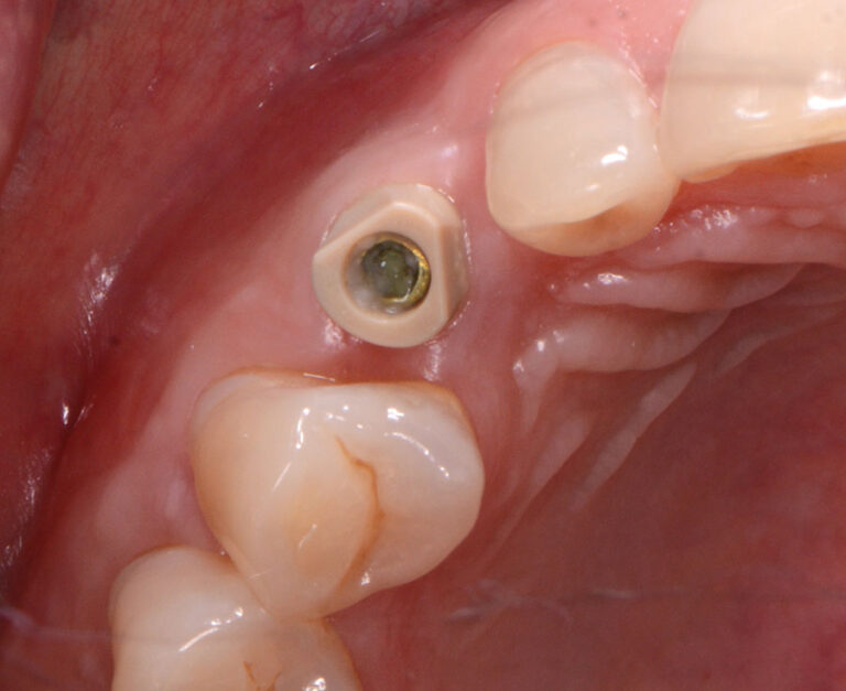 . 6 weeks of healing occlusal view.