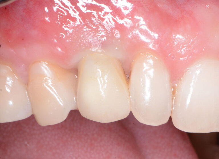 Final screw-retained zirconia crown delivered at 9 weeks.