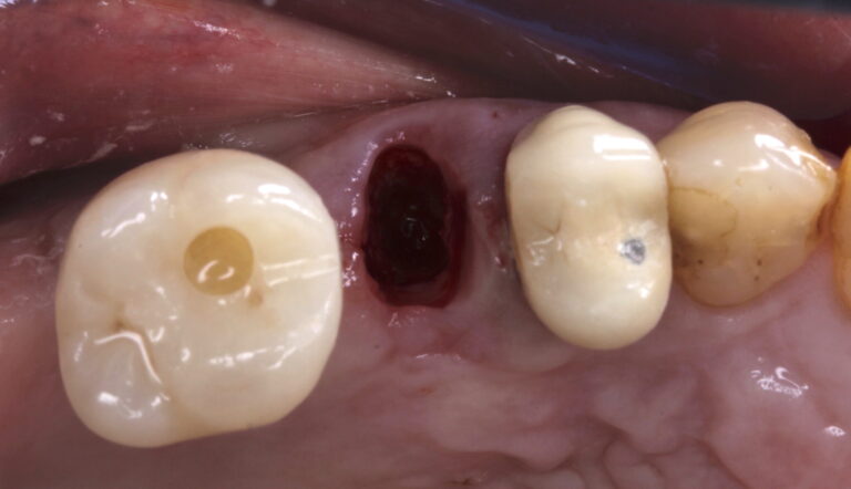 Post-extraction clinical (occlusal).