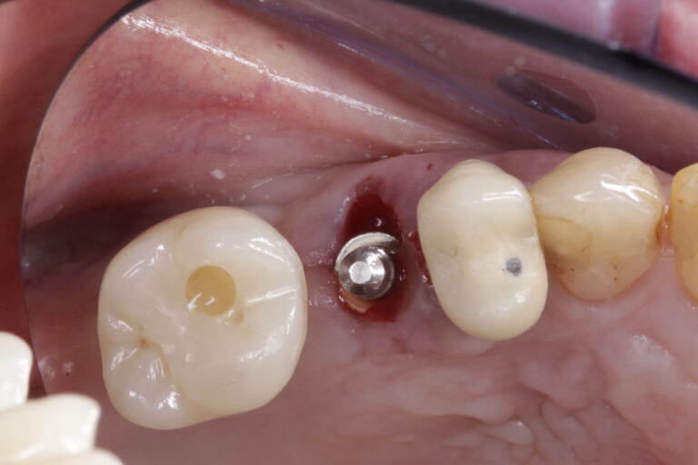 Directional indicator in place (occlusal.) 