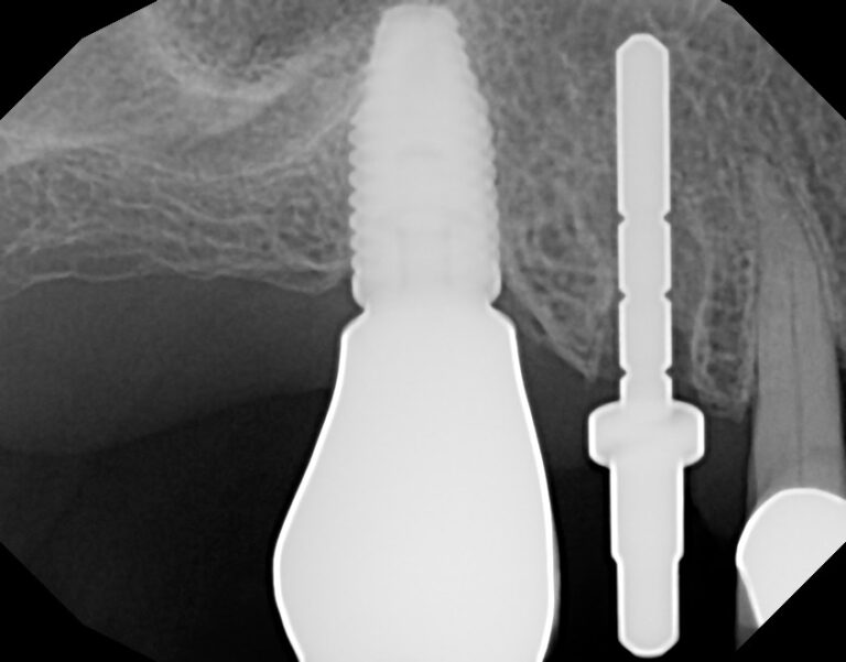 Radiograph of directional indicator to verify trajectory. 