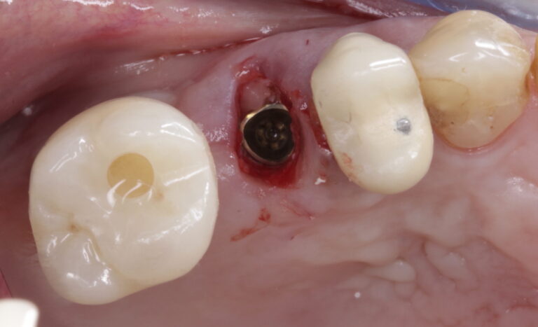 . Implant placed with flat aspect of trioval shape oriented to the buccal aspect.