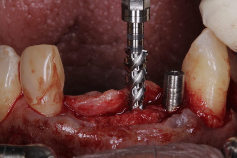 The OsseoshaperTM creates the customized osteotomy for each specific implant it is packaged with.