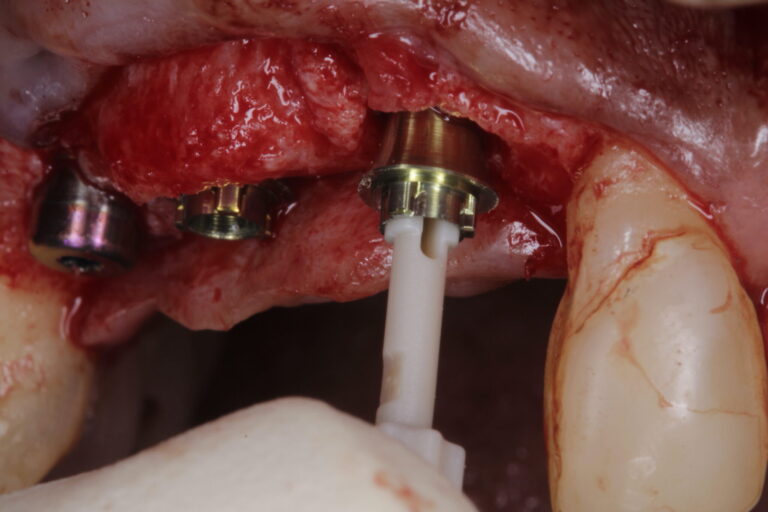  The N1TM Base can be seen being placed to create the “One abutment-One time” protocol. 