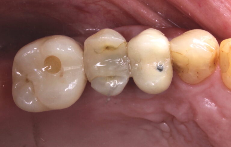 Initial occlusal presentation for Case 1.