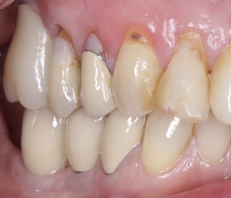 Initial buccal presentation for Case 1. Note the buccal recession.