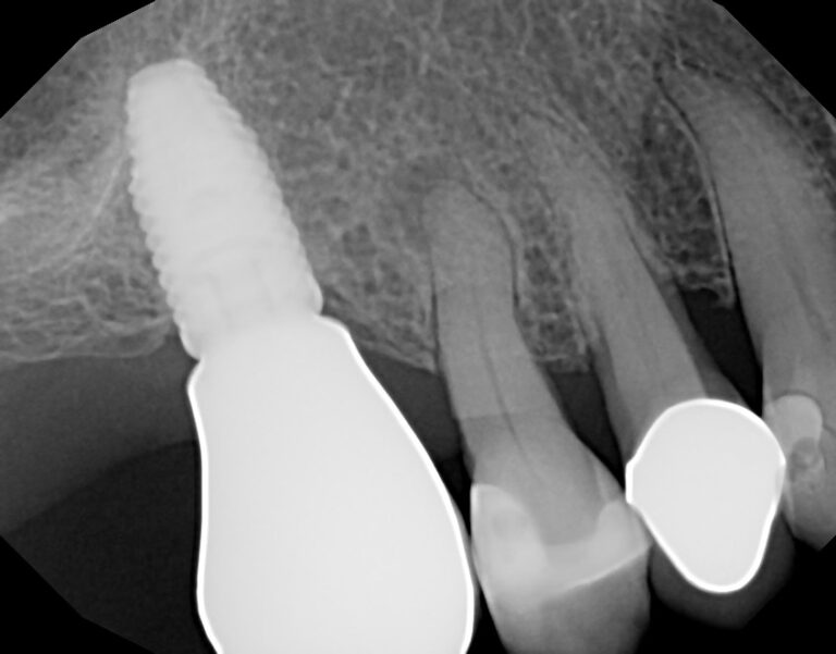  Initial radiographic presentation. Note the periapical radiolucency.