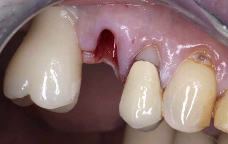 Post-extraction clinical view (buccal).