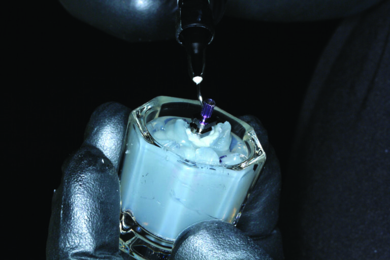Flowable composite injection.