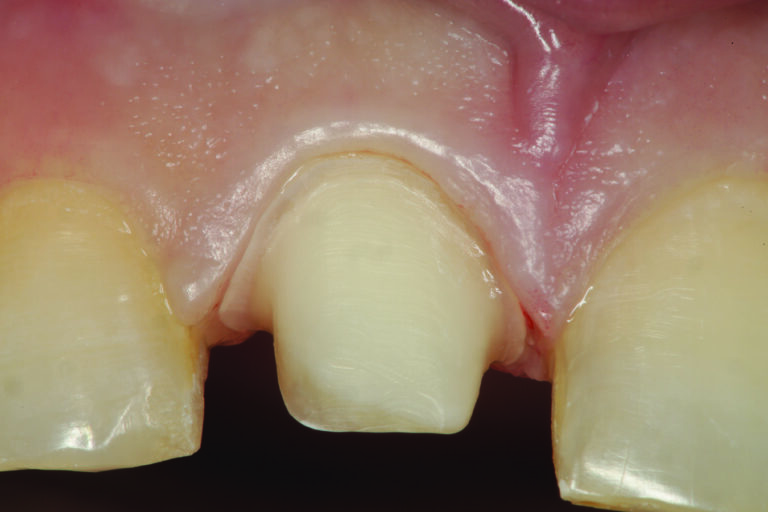 A facial view of the completed preparation of tooth # 8.