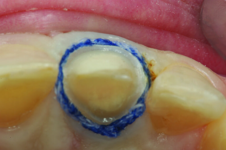  An incisal view of the retracted preparation after the gingivoplasty is completed. 