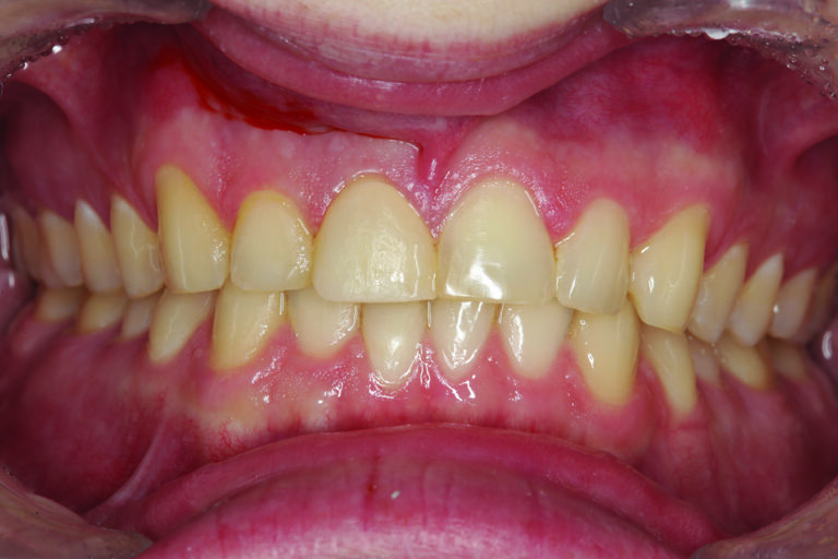 . A facial retracted view of tooth #8 after provisionalization. The provisional restoration is important to judge the aesthetic consideration and evaluate the functional occlusion, protrusion, anterior coupling, and the envelope of function. It is much more than “just a temporary!”