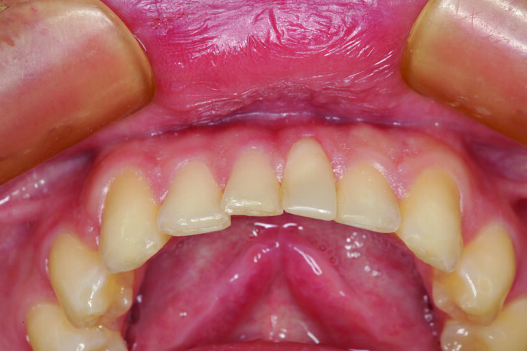 An incisal view of the direct composite restoration of tooth #25. Not the incisal edge alignment as compared to the preoperative view in Figure 3. 