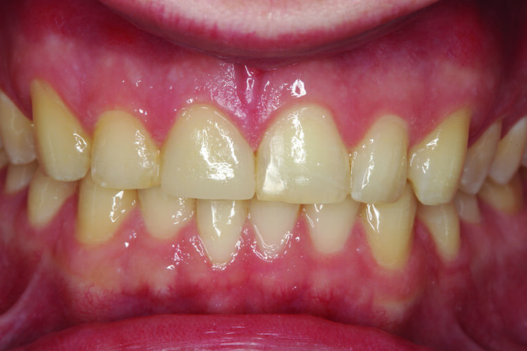 A six-month post-operative retracted facial view of the restorations on tooth numbers 8 and 25. Aesthetic and functional harmony have been achieved.