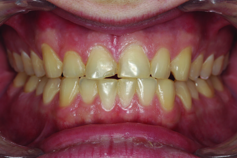 In a protrusive excursion, excessive wear can be seen on the opposing tooth (# 25) that articulates with tooth # 8, indicating hyperfunction and increased functional stress on the restored area.