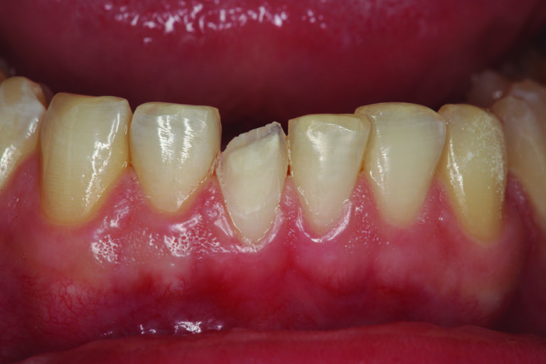Tooth # 25 is “orthodontically” prepared on the facial aspect to create space so that restoration of that surface can correct the facial position of the tooth in the occlusion.