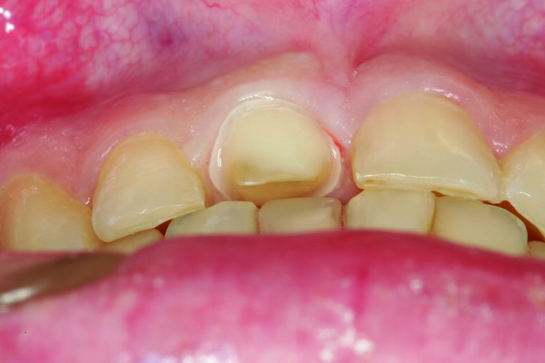  An inferior view shows tooth # 8 after the preparation has been completed and the patient is in Centric Occlusion (maximum intercuspation). Note how the restoration of tooth # 25 was needed to position the incisal edge and facial surface in a more lingualized position to allow for the space required to restore the palatal surface of tooth # 8 at the proper thickness while maintaining the natural palatal concavity determined in part by occlusal excursive patterns.