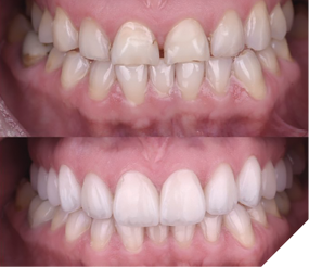 Intraoral-Before and after.