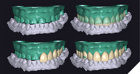 . Different views of the digital wax-up using scanned models and Exocad.