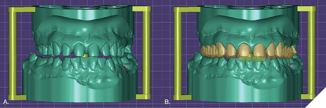 5A. Prep on Exocad model. 5B. Merge of the mock-up with the preps for the final restoration.