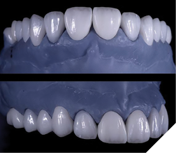 Final restorations using milled lithium disilicate EMax blocks and staining.