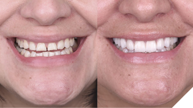 . Before and after of esthetic case using a digital workflow.