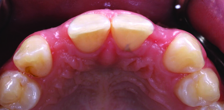 Preoperative occlusal view.