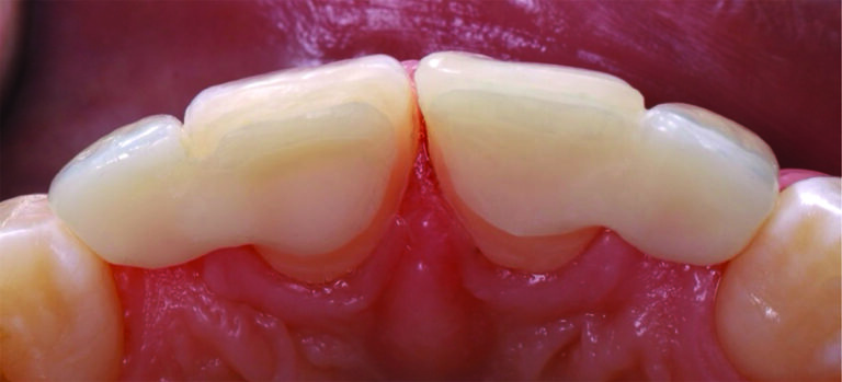 Single-wing zirconia bonded fixed prosthesis.