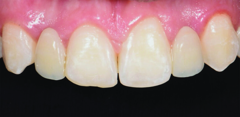 Post-operative facial view of zirconia bonded fixed prosthesis.