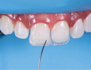Direct Anterior Resin Composite Restorations: An Update on Esthetic ...