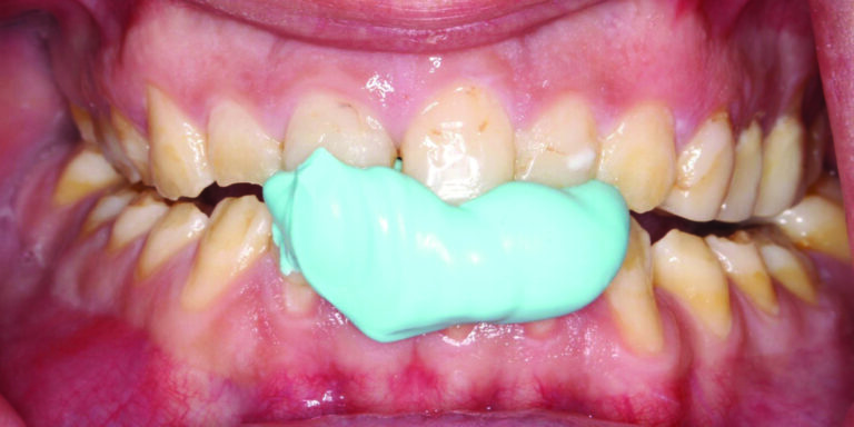 Prior to preparation of mandibular arch, anterior VDO captured in CR using Genie Bite (Sultan Healthcare) bite registration material.