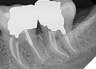 Case 1 by Dr. Mahmood Reza Kalantar Motamedi. (Restoration by Dr. Pardis Doosti)