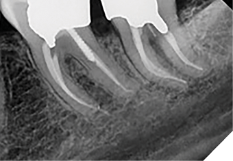 Case 1 by Dr. Mahmood Reza Kalantar Motamedi. (Restoration by Dr. Pardis Doosti)