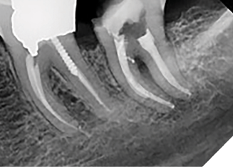 Case 1 by Dr. Mahmood Reza Kalantar Motamedi. (Restoration by Dr. Pardis Doosti)
