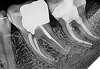 Case 1 by Dr. Mahmood Reza Kalantar Motamedi. (Restoration by Dr. Pardis Doosti)